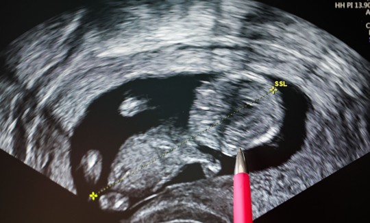 Women seeking abortions in Pennsylvania may be offered ultrasounds of the fetus, as shown above.