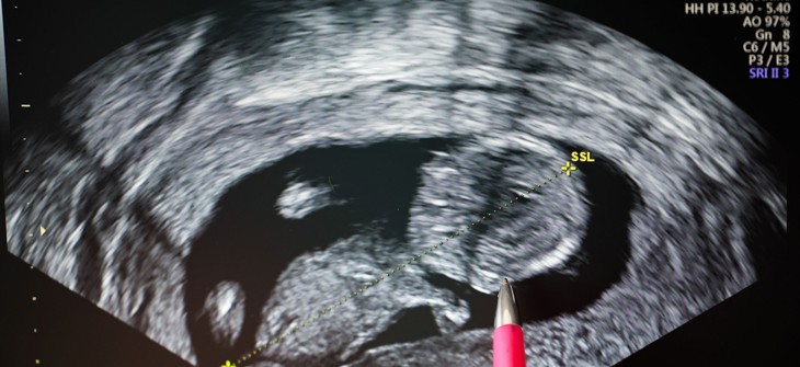 Women seeking abortions in Pennsylvania may be offered ultrasounds of the fetus, as shown above.