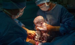 A cesarean section delivery. 