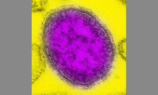 Transmission electron micrograph of a single virus particle, or virion, of measles virus