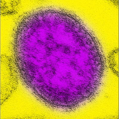 As Pennsylvania’s measles outbreak hit disturbing new milestones this week – including the country’s largest reported measles death total since the 1990s – tensions flared again between Gov. Josh Shapiro and federal health czar Robert F. Kennedy Jr. ov…